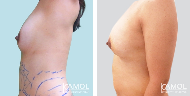 Breast Lift by Incision Scar around Areola (O scar) with implant