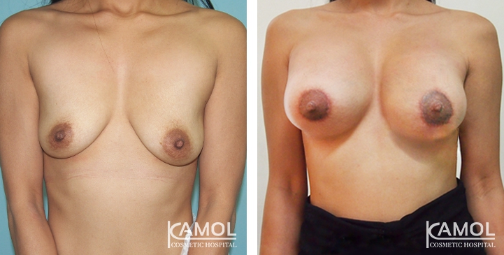Breast Lift by Incision Scar around Areola (O scar) with implant