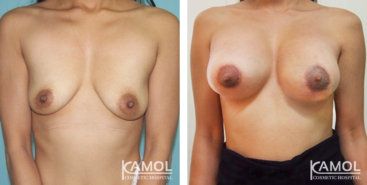 Breast Lift by Incision Scar around Areola (O scar) with implant 