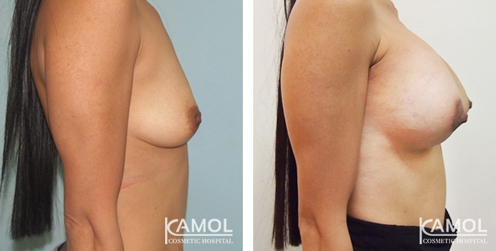 Breast Lift by Incision Scar around Areola (O scar) with implant 