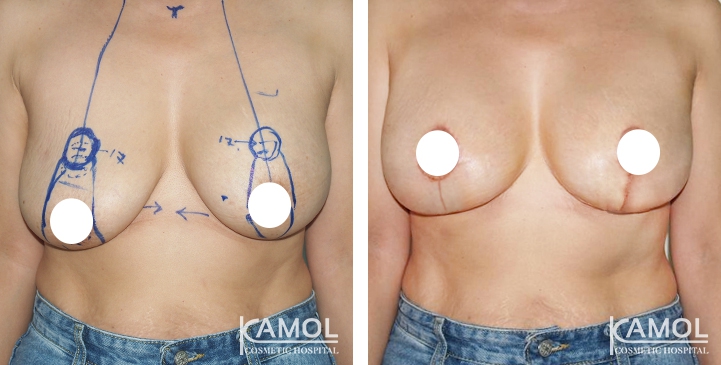 Breast Lift by Inverted T-scar
