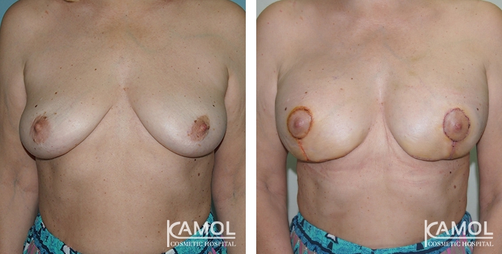 Before and After surgery 10 days Breast Lift by Inverted T-scar with implant