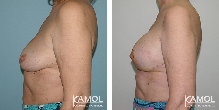 Before and After surgery 10 days Breast Lift by Inverted T-scar with implant