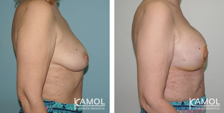 Before and After surgery 10 days Breast Lift by Inverted T-scar with implant