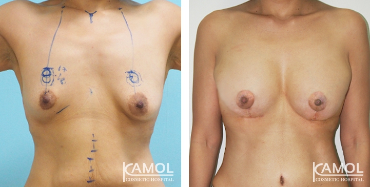 Before and After surgery 1 months Breast Lift by Inverted T-scar with implant