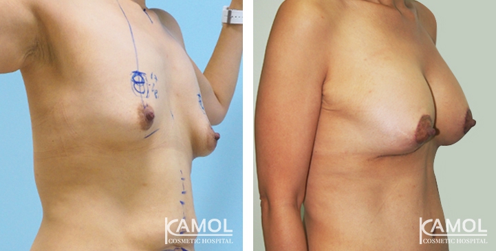Before and After surgery 1 months Breast Lift by Inverted T-scar with implant