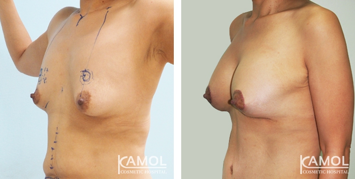 Before and After surgery 1 months Breast Lift by Inverted T-scar with implant