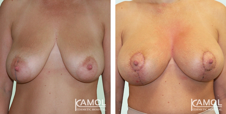 Before and After surgery 2 weeks Breast Lift by Inverted T-scar with implant