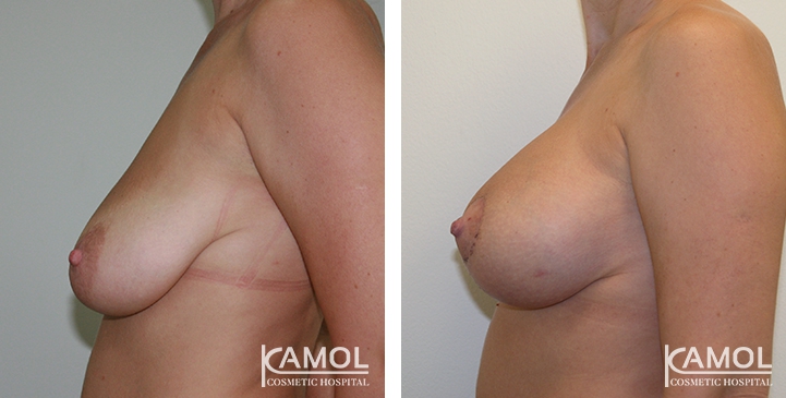 Before and After surgery 2 weeks Breast Lift by Inverted T-scar with implant