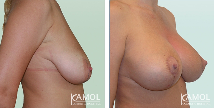 Before and After surgery 2 weeks Breast Lift by Inverted T-scar with implant