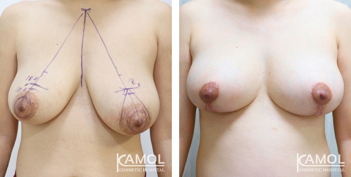 Before and After surgery 1 months Breast Lift by Inverted T-scar