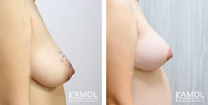 Before and After surgery 1 months Breast Lift by Inverted T-scar