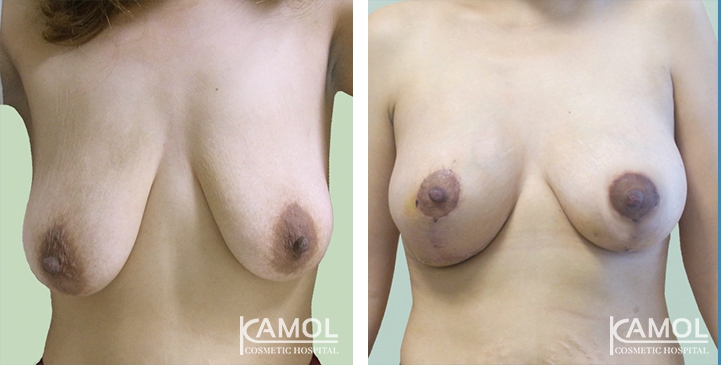 Before and After surgery 2 weeks Breast Reduction by inverted T-scar