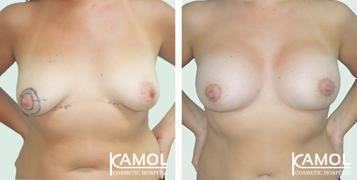 Before and After surgery 2 weeks Breast lift with implant by Peri-Areolar insision technique