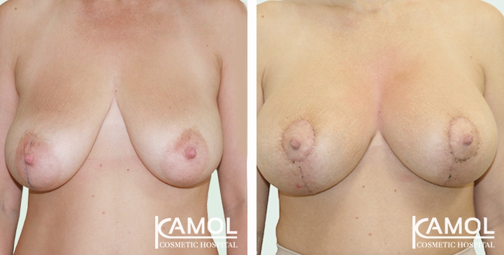 Before and After surgery 1 month Breast lift with implant by T-Inverted technique