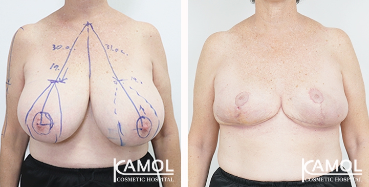 Breast lift and breast reduction after surgery 30 days