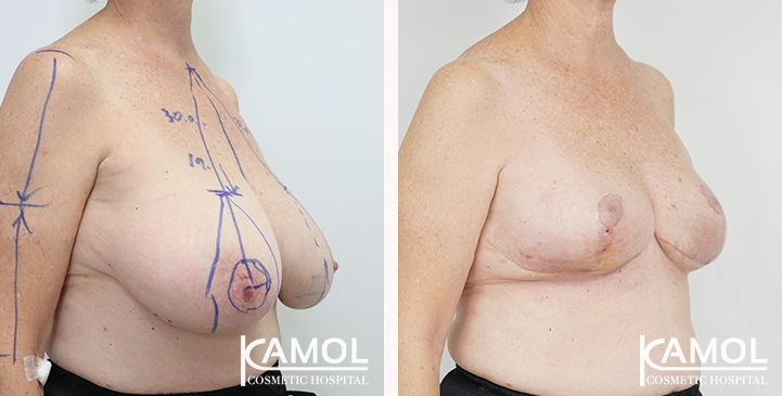 Breast lift and breast reduction after surgery 30 days