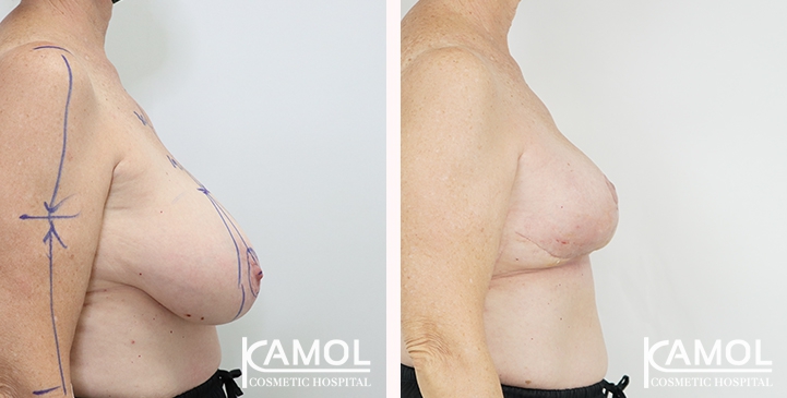 Breast lift and breast reduction after surgery 30 days