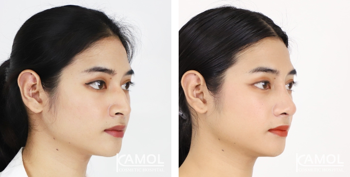 Before and After Rhinoplasty, Nose Job, Nose Surgery