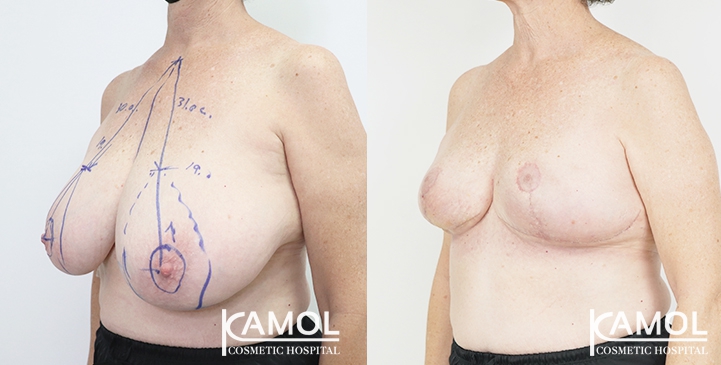  Breast lift and breast reduction after surgery 30 days 