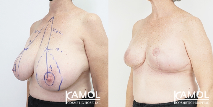 Breast lift and breast reduction after surgery 30 days