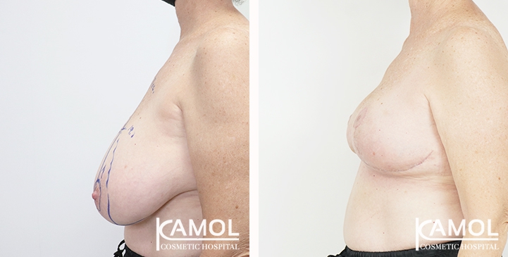 Breast lift and breast reduction after surgery 30 days