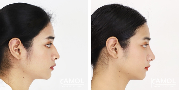 Before and After Rhinoplasty, Nose Job, Nose Surgery