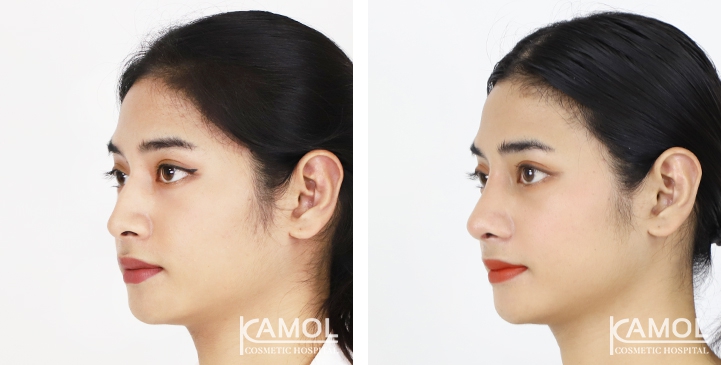 Before and After Rhinoplasty, Nose Job, Nose Surgery