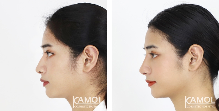 Before and After Rhinoplasty, Nose Job, Nose Surgery