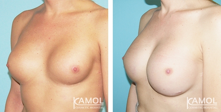 Before and After Capsular Contracture revision with new implant