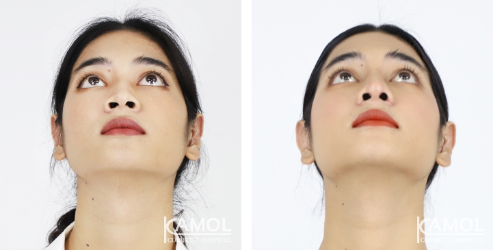 Before and After Rhinoplasty, Nose Job, Nose Surgery