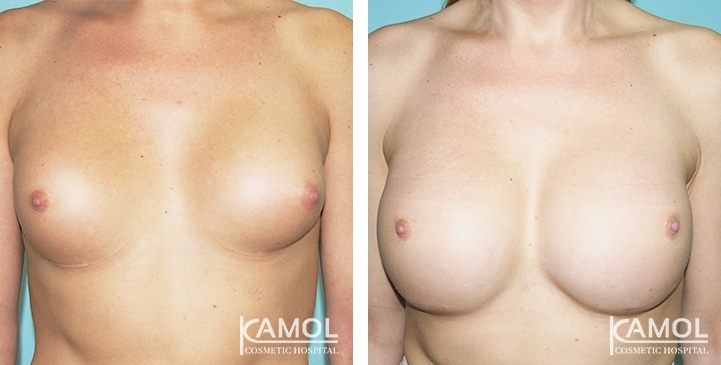 Before and After Capsular Contracture revision with new implant