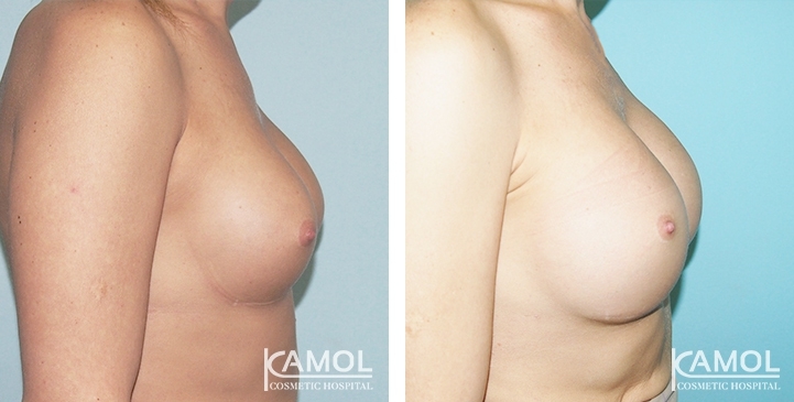 Before and After Capsular Contracture revision with new implant