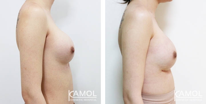 Before and After breast implant revision by upward correction