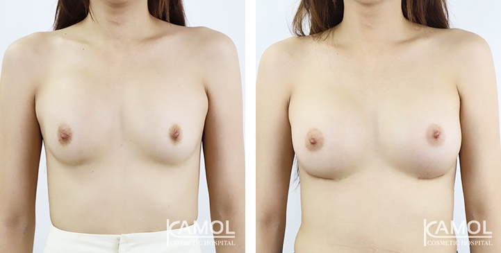 Before and After breast implant revision by upward correction