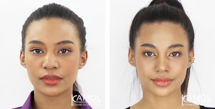 Before and After Rhinoplasty, Nose Job, Nose Surgery