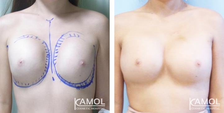 Before and After breast implant revision by Cleavage Breast correction