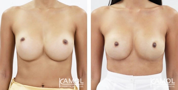 Before and After breast implant revision by Symmastia correction
