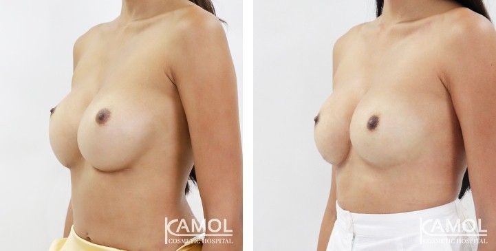 Before and After breast implant revision by Symmastia correction