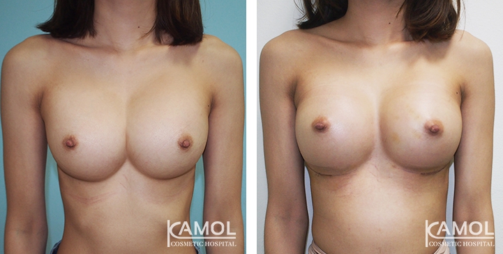 Before and After breast implant revision by Symmastia correction