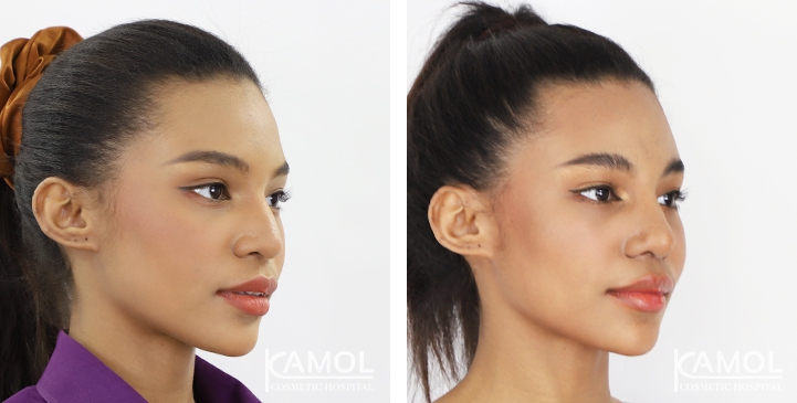 Before and After Rhinoplasty, Nose Job, Nose Surgery