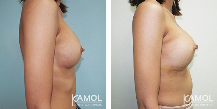 Before and After breast implant revision by Symmastia correction