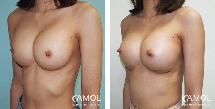 Before and After breast implant revision by Symmastia correction