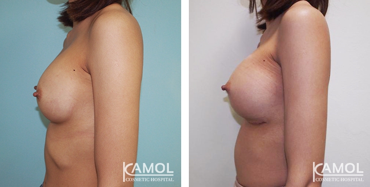 Before and After breast implant revision by Symmastia correction