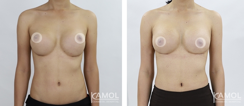 Before and After breast implant revision