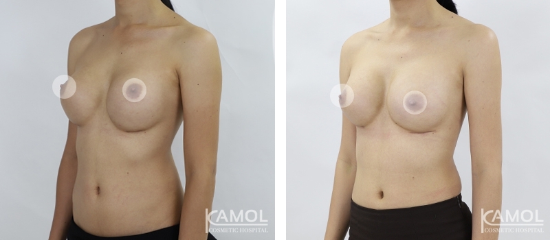 Before and After breast implant revision