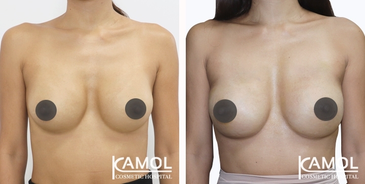 Before and After breast implant revision