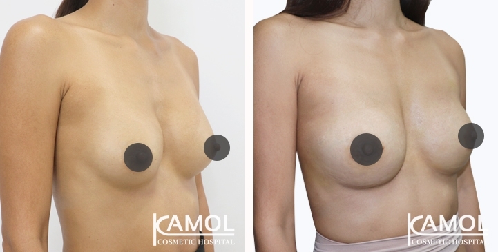 Before and After breast implant revision