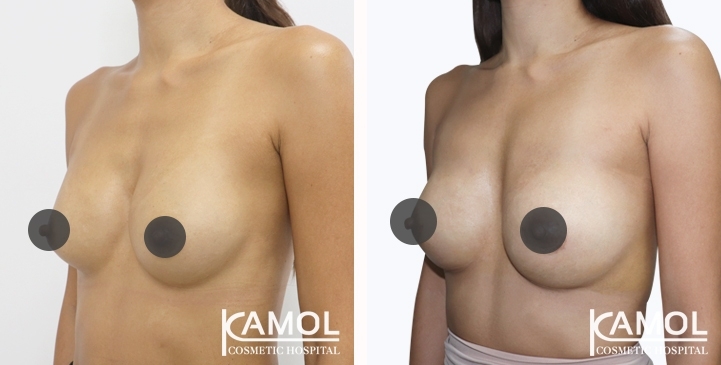 Before and After breast implant revision