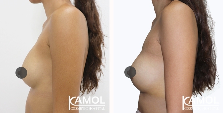 Before and After breast implant revision